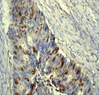 Immunohistochemistry (Formalin/PFA-fixed paraffin-embedded sections) - Anti-Survivin antibody [EP2880Y] (ab76424), expandable thumbnail