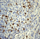 Immunohistochemistry (Formalin/PFA-fixed paraffin-embedded sections) - Anti-Survivin antibody [EP2880Y] (ab76424), expandable thumbnail