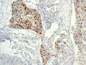 Immunohistochemistry (Formalin/PFA-fixed paraffin-embedded sections) - Anti-Survivin antibody [EP2880Y] (ab76424), expandable thumbnail