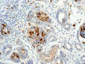 Immunohistochemistry (Formalin/PFA-fixed paraffin-embedded sections) - Anti-Survivin antibody [EP2880Y] (ab76424), expandable thumbnail