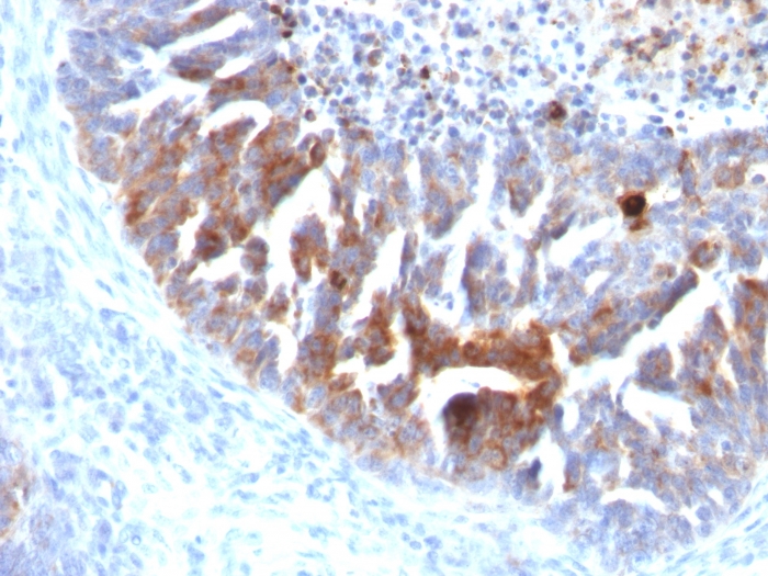 Immunohistochemistry (Formalin/PFA-fixed paraffin-embedded sections) - Anti-tag-72 antibody [B72.3 + CC49] (AB199002), expandable thumbnail