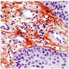 Immunohistochemistry (Formalin/PFA-fixed paraffin-embedded sections) - Anti-Tenascin C antibody [SPM319], prediluted (AB54348)