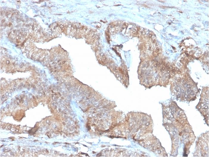 Immunohistochemistry (Formalin/PFA-fixed paraffin-embedded sections) - Anti-Thymidine Phosphorylase antibody [rTYMP/3444] (AB270728), expandable thumbnail