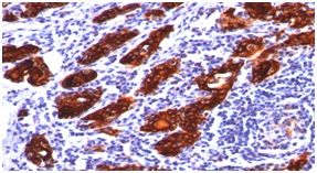 Immunohistochemistry (Formalin/PFA-fixed paraffin-embedded sections) - Anti-Thyroglobulin antibody [2H11] (AB187378), expandable thumbnail