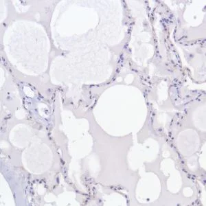 Immunohistochemistry (Formalin/PFA-fixed paraffin-embedded sections) - Anti-TROP2 antibody [SP294] - BSA and Azide free (AB238789)