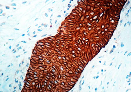 Immunohistochemistry (Formalin/PFA-fixed paraffin-embedded sections) - Anti-wide spectrum Cytokeratin antibody (AB9377), expandable thumbnail