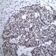 Immunohistochemistry (Formalin/PFA-fixed paraffin-embedded sections) - Anti-Wilms Tumor Protein antibody [CAN-R9(IHC)-56-2] - BSA and Azide free (ab216646), expandable thumbnail