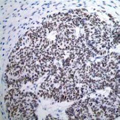 Immunohistochemistry (Formalin/PFA-fixed paraffin-embedded sections) - Anti-Wilms Tumor Protein antibody [CAN-R9(IHC)-56-2] - BSA and Azide free (AB216646)