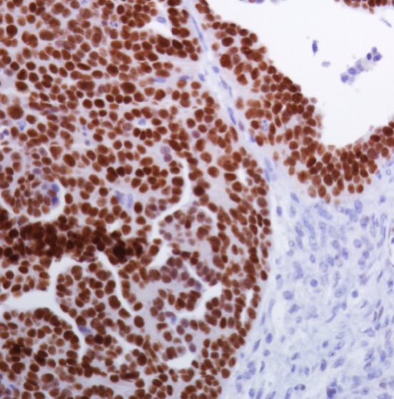Immunohistochemistry (Formalin/PFA-fixed paraffin-embedded sections) - Anti-Wilms Tumor Protein antibody [SP320] - BSA and Azide free (ab242423), expandable thumbnail