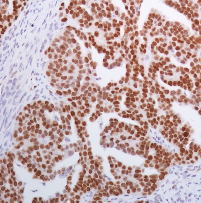Immunohistochemistry (Formalin/PFA-fixed paraffin-embedded sections) - Anti-Wilms Tumor Protein antibody [SP321] (ab224806), expandable thumbnail