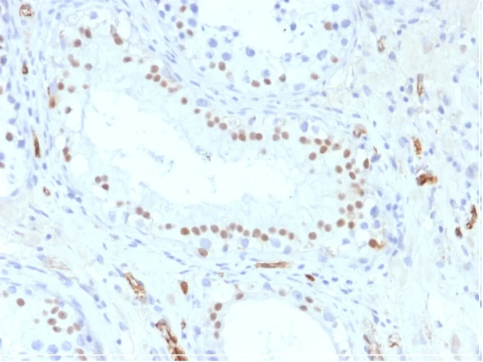 Immunohistochemistry (Formalin/PFA-fixed paraffin-embedded sections) - Anti-Wilms Tumor Protein antibody [WT1/857] (AB220212)