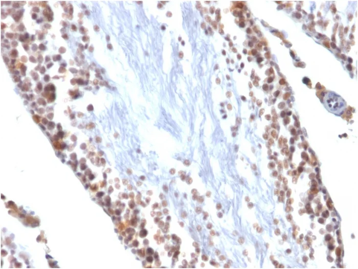 Immunohistochemistry (Formalin/PFA-fixed paraffin-embedded sections) - Anti-Wilms Tumor Protein antibody [WT1/857] (AB220212)