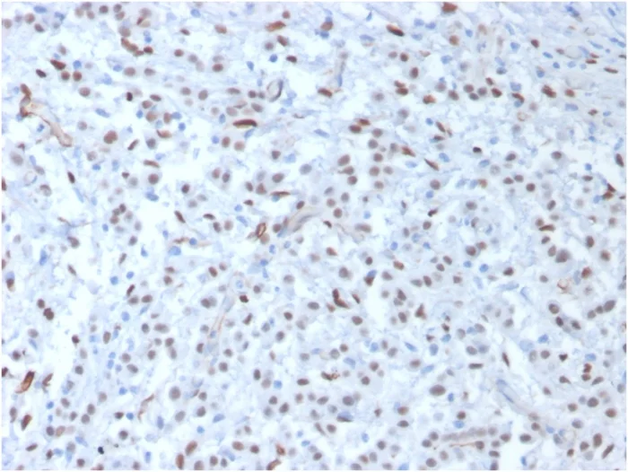 Immunohistochemistry (Formalin/PFA-fixed paraffin-embedded sections) - Anti-Wilms Tumor Protein antibody [WT1/857] (AB220212)