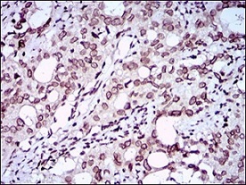 Immunohistochemistry (Formalin/PFA-fixed paraffin-embedded sections) - Anti-ZEB1 antibody [2A8A6] (ab181451), expandable thumbnail