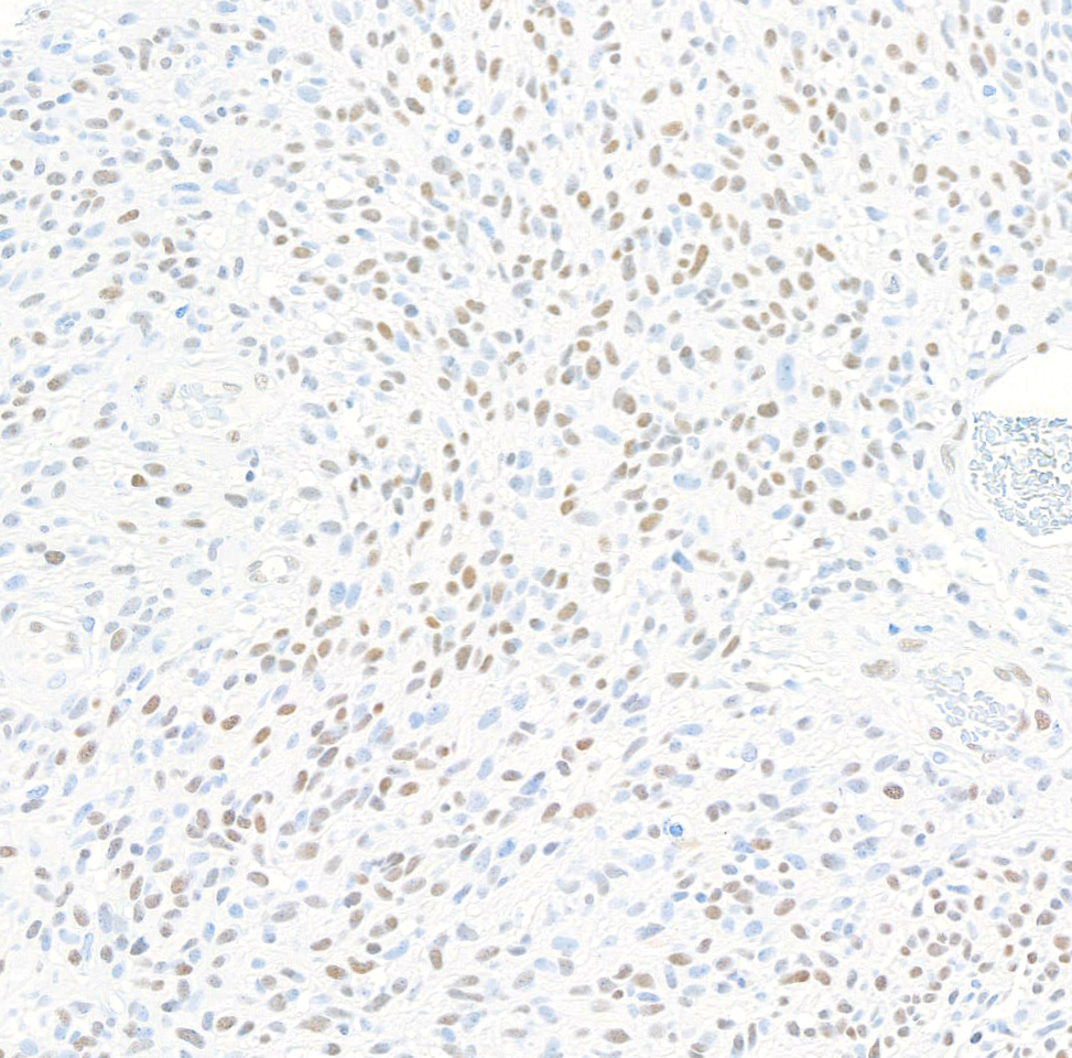Immunohistochemistry (Formalin/PFA-fixed paraffin-embedded sections) - Anti-ZEB1 antibody [BLR217K] - BSA free (ab314092), expandable thumbnail